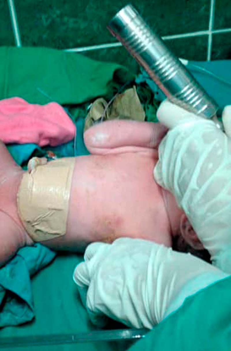 Corregido el defecto congénito de la niña operacion recien nacida 177