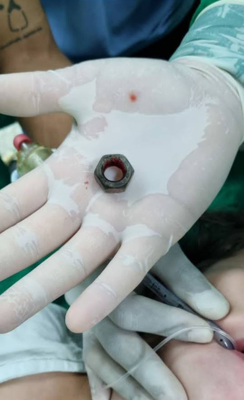 Es la tuerca que la niña había tragado y fue extraída de su esófago. niña pediatrico 3