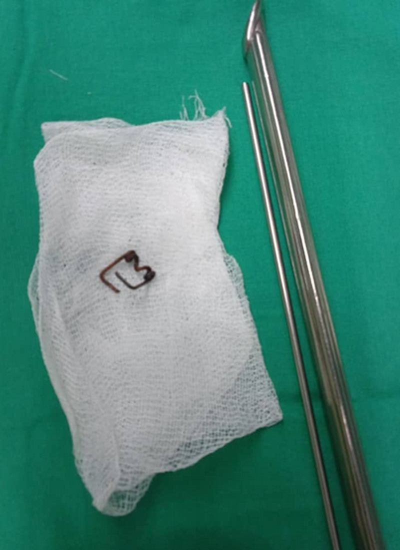 A nivel de esófago tenía el bebé este muelle metálico. MEDICOS MUELLE 3