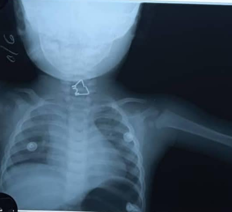 Rayos X realizado de urgencia al niño. MEDICOS MUELLE 4
