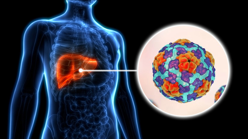 hepatitis A