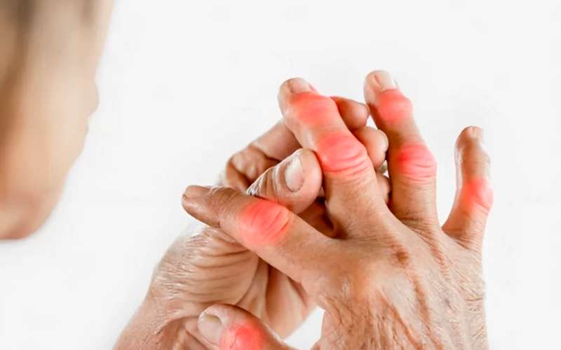 artritis reumatoide