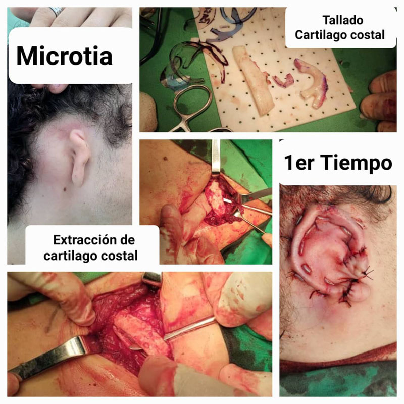cirugia microtia 02